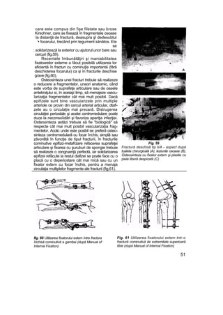 care este compus din fişe filetate sau brose
Kirschner, care se fixează în fragmentele osoase
la distanţă de fractură, deasupra şî dedesubtul
'• focarului, trecând prin tegument sănătos. Ele
se
: solidarizează la exterior cu ajutorul unor bare sau
cercuri (fig.59).
Recentele îmbunătăţiri şi maniabilitatea
fixatoarelor externe a făcut posibilă utilizarea lor
eficientă în fracturi cu cominuţîe importantă (fără
deschiderea focarului) ca şi în fracturile deschise
grave (fig.60),
Osteosinteza unei fracturi trebuie să realizeze
o reducere a fragmentelor, uneori anatomic, când
este vorba de suprafeţe articulare sau de oasele
antebraţului si, In aceiaşi timp, să menajeze vascu-
îarizaţia fragmentelor cât mai mult posibil. Dacă
epifizele sunt bine vascuiarizate prin multiple
arteriole ce provin din cercul arterial articular, dtafi-
zele au o circulaţie mai precară. Distrugerea
circulaţiei periostale şi acelei centromedulare poate
duce la neconsoîidări şi favoriza apariţia infecţiei.
Osteosinteza astăzi trebuie să fie "biologică" să
respecte cât mai mult posibil vascularizaţia frag-
mentelor. Acolo unde este posibil se preferă osteo-
sinteza centromedulară cu focar închis, simplă sau
zăvorâtă In funcţie de tipul fracturii, în fracturile
cominutive epifizo-metafrzare refacerea suprafeţei
articulare şi fixarea cu şuruburi de spongie trebuie
să realizeze o congruenţă perfectă, iar solidarizarea
epifizei refăcute la restul diafizei se poate face cu o
placă cu o deperiostare cât mai mică sau cu un
fixator extern cu focar închis, pentru a menaja
circulaţia multiplelor fragmente ale fracturii (fig.61).
Fig. 59
Fractură deschisă tip li/A - aspect după
toaleta chirurgicală (A), leziunile osoase (B),
Osteosinteza cu fixator extern şi plastie cu
piele liberă despicată (C)
fig. 60 Utilizarea fixatorului extern între fractura
închisă cominutivă a gambei (după Manual of
Internai Fixation)
Fig. 61 Utilizarea fixatorului extern tntr-o
fractură cominutivă de extremitate superioară
tibie (după Manual of Internai Fixation)
51
 