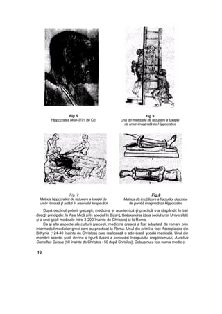 Fig.S
Hippocrates (460-3701 de Cr)
Fig.S
Una din metodele de reducere a tuxaţiei
de umăr imaginată de Hippocrates
F/g. 7
Metoda hippocratică de reducere a luxaţiei de
umăr rămasă şl astăzi în arsenalul terapeuticii
Fig,8
Metoda d& imobilizare a fracturilor deschise
de gambă imaginată de Hippocrates
După declinul puterii greceşti, medicina ei academică şi practică s-a răspândit în trei
direcţii principale: în Asia Mică şi în special în Bizanţ, ttiAlexandria (deja sediul unei Universităţi
şi a unei şcoli medicale între 3-200 înainte de Christos) si la Roma.
Ca şi alte aspecte ale culturii greceşti, medicina greacă a fost adaptată de romani prin
intermediul medicilor greci care au practicat la Roma. Unul din primii a fost Asctepiades din
Bithynia (124-40 înainte de Christos) care realizează o adevărată şcoală medicală. Unul din
membrii acestei şcoli devine o figură ilustră a perioadei începutului creştinismului, Aurelius
Comefius Celsus (50 înainte de Christos - 50 după Chrisîos}. Celsus nu a fost numai medic ci
10
 