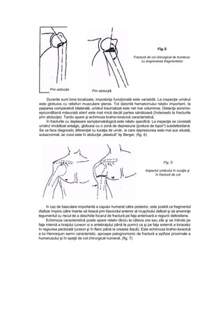 Prin abducţi&
Fig.S
Fractură de coi chirurgical de humerus
cu angrenarea fragmentelor
Durerile sunt bine localizate, impotenţa funcţională este variabilă. La inspecţie umărul
este globuios cu reliefuri musculare şterse. Tot datorită hematornului relativ important, la
paiparea comparativă bilaterală, umărul traumatizat este net mai voluminos. Distanţa acromio-
epicondlliană măsurată aîenî este mat mică decât partea sănătoasă {îndeosebi la fracturile
prin abducţie). Tardiv apare şi echimoza brahio-toracică caracteristică,
în fracturile cu deplasare ssmptomatologică este relativ specifică. La inspecţie se constată
umăru! imobilizat antalgic, globuios cu o zonă de depresiune (jovitura de topor") subdettoidiană.
Se va face diagnostic diferenţial cu luxaţia de umăr, ia care depresiunea este mai sus situată,
subacromial, iar coiul este în abducţie „elastică" tip Berger, (fig. 6)
Flg, S
Aspectul umărului în iuxaţie şi
în fractură de cot
în caz de basculare importantă a capului humerat către posterior, este posibil ca fragmentul
dîafizar împins către înainte să treacă prin fascicolul anterior al muşchiului deltoid şi să ameninţe
tegumentul cu riscul de a deschide focarul de fractură pe faţa anterioară a regiunii deltoidiene.
Echimoza caracteristică poate apare relativ târziu la câteva ore sau zile şi se întinde pe
faţa internă a braţului (uneori si a antebraţului până la pumn) ca şi pe faţa externă a toracelui
în regiunea pectorală (uneori şi în flanc până ia creasta iliacă). Este echimoza brahio-toractcă
a lui Hennequin semn caracteristic, aproape patognomonic de fractură a epifizei proximale a
humerusului şi în speţă de col chirurgical numeral, (fig. 7)
Prin adducţie
 