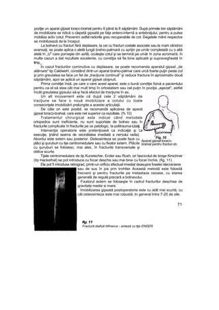 poziţie un aparat gîpsat toracc-brahial pentru 6 până la 8 săptămâni. După primele trei săptămâni
de imobilizare se ridică o clapetă gipsată pe faţa antero-internă a antebraţului, pentru a putea
mobiliza activ cotul. Prevenim astfel redorile greu recuperabile de cot. Degetele mânii respectve
se mobilizează de la început.
La bolnavii cu fracturi fără deplasare, la cei cu fracturi costale asociate sau la marii vârstnici
avansaţi, se poate aplica o alelă lungă brahio-palrnară cu sprijin pe umăr completată cu o altă
atelă în „U" care porneşte din axîlâ, ocoleşte cotul şi se termină pe umăr în zona acromia!ă. în
multe cazuri a dat rezultate excelente, cu condiţia să fie bine aplicată şi supravegheată în
timp._
In cazul fracturilor cominutive cu deplasare, se poate recomanda aparatul gipsaî „de
atârnare" tip CaldweH, constând dintr-un aparat brahio-palmar care urcă foarte puţin peste coî
şi prin greutatea sa face un fel de „tracţiune continuă" şi reduce fractura în aproximativ două
săptămâni, apoi se aplică un aparat gipsat obişnuit.
Prima condiţie însă, pe care o cere acest aparat, este o bună condiţie fizică a pacientului
pentru ca el să stea cât mai mult timp în ortostatism sau cel puţin în poziţia „aşezat", astfel
încât greutatea gipsului să-şi facă efectul de tracţiune în ax,
Un alt incovenient este că după cele 2 săptămâni de
tracţiune se face o nouă imobilizare a cotului cu toate
consecinţele imobilizării prelungite a acestei articulaţii.
De câte ori este posibil, se recomandă aplicarea de aparat
gipsat toraco-brahial, care este net superior ca rezultate. {% 10)
Tratamentul chirurgical este indicat când metodele
ortopedice sunt ineficiente, nu sunt suportate de bolnav sau în
fracturile complicate în fracturile pe os patologic, Ia politrauma-tJzaţi,
Intervenţia operatorie este pretenţioasă ca indicaţie şi ca
execuţie, ţinând seama de vecinătatea imediată a nervului radia).
Abordui este extern sau posterior. Osteosinteza se poate face cu
plăci şi şuruburi cu tije centromedulare sau cu fixator extern. Plăcile
cu şuruburi se folosesc, mai ales, în fracturile transversale şi
oblice scurte.
Tijele centromedulare de tip Kunstscher, Ender sau Rush, ori fascicolul de broşe Kirschner
(tip Hackethal) se pot introduce cu focar deschis sau mai bine cu focar închis, (fig, 11)
Ele pot fi introduse retrograd, printr-un orificiu efectuat imediat deasupra fosetei olecraniene
sau de sus în jos prin trohtter Această metodă este folosită
frecvent şi pentru fracturile pe metastaze osoase, cu starea
generală de regulă precară a bolnavului.
Fixatorul extern se foloseşte în cadrul fracturilor deschise de
gravitate medie si mare.
Imobilizarea gipsată postoperatorie este cu atât mai scurtă, cu
cât osteosinteza este rnai robustă, tn general Intre 7-20 de zile.
71
Fig, 10
Aparat gipsat toraco-
brahial pentru fracturi do
humerus
fig. 11
Fractură diafiză htfmerus - sinteză cu ttje ENDER
 