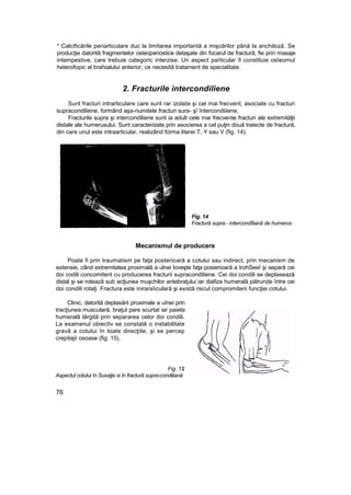 * Calcificările periarticulare duc la limitarea importantă a mişcărilor până la anchiloză. Se
producţie datorită fragmentelor osteoperiostice detaşate din focarul de fractură, fie prin masaje
intempestive, care trebuie categoric interzise. Un aspect particular îl constituie osîeomul
heterofopic al brahialului anterior, ce necesită tratament de specialitate.
2. Fracturile intercondiliene
Sunt fracturi intrarticulare care sunt rar izolate şi cel mai frecvent, asociate cu fracturi
supracondiliene, formând aşa-numitele fracturi sura- şî întercondiiiene,
Fracturile supra şi intercondiliene sunt ia adult cele mai frecvente fracturi ale extremităţii
distale ale humerusului. Sunt caracterizate prin asocierea a cel puţin două traiecte de fractură,
din care unul este intraarticular, realizând forma literei T, Y sau V (fig. 14).
Fig. 14
Fractură supra - intercondîliană de humerus
Mecanismul de producere
Poate fi prin traumatism pe faţa posterioară a cotului sau indirect, prin mecanism de
extensie, când extremitatea proximală a ulnei loveşte faţa posierioară a trohSeeî şi separă cei
doi codili concomitent cu producerea fracturii supracondiliene. Cei doi condili se deplasează
distal şi se rotează sub acţiunea muşchilor antebraţului iar diafiza humerală pătrunde între cei
doi condili rotaţi. Fractura este iniraraîiculară şi există riscul compromiterii funcţiei cotului.
Clinic, datorită deplasării proximale a uînei prin
tracţiunea musculară, braţul pare scurtat iar paieta
humeralâ lărgită prin separarea celor doi condili.
La examenul obiectiv se constată o instabilitate
gravă a cotului în toate direcţiile, şi se percep
crepitajii osoase (fig. 15).
Fig. 1$
Aspectul cotului în Suxaţie si în fractură supra-condiiiană
76
 
