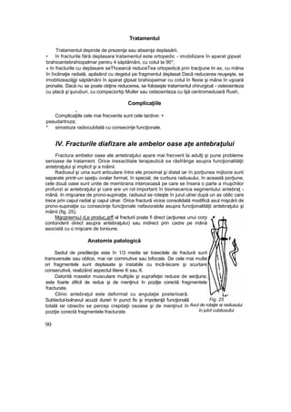 Tratamentul
Tratamentul depinde de prezenţa sau absenţa deplasării,
• In fracturile fără deplasare tratamentul este ortopedic - imobilizare în aparat gipsat
brahioantebrahiopalmar pentru 4 săptămâni, cu cotul ta 90°;
» In fracturile cu deplasare seThcearcă reduceTea ortopedică prin tracţiune tn ax, cu mâna
în înclinaţie radială, apăsând cu degetul pe fragmentul deplasat Dacă reducerea reuşeşte, se
irnobtiizeazăjjji săptămâni în aparat gtpsat brahiopaimar cu cotul în flexie şi mâna în uşoară
pronatie. Dacă nu se poate obţine reducerea, se foloseşte tratamentul chirurgical - osteosinteza
cu placă şi şuruburi, cu compaciortip Muller sau osteosinteza cu tijă centromeduiară Rush,
Complicaţiile
4
Complicaţiile cele mai frecvente sunt cele tardive: +
pseudartroza;
* sinostoza radiocubitală cu consecinţe funcţionale.
IV. Fracturile diafizare ale ambelor oase aţe antebraţului
Fractura ambelor oase ale antebraţului apare mai frecvent la adulţi şi pune probleme
serioase de tratament. Orice inexactitate terapeutică se răsfrânge asupra funcţionalităţii
antebraţului şi implicit şi a mâinii.
Radiusul şi uina sunt articulare între ele proximal şi distal iar în porţiunea mijlocie sunt
separate printr-un spaţiu ovalar format, în special, de curbura radiusului, în această porţiune,
cele două oase sunt unite de membrana interosoasă pe care se însera o parte a muşchilor
profunzi ai antebraţului şi care are un rol important în biomecanica segmentului antebraţ -
mână. In mişcarea de prono-supinaţie, radiusul se roteşte în jurul ulnei după un ax oblic care
trece prin capul radial şi capul ulnar. Orice fractură vicios consolidată modifică axul mişcării de
prono-supinaţie cu consecinţe funcţionale nefavorabile asupra funcţionalităţii antebraţului şi
mâinii (fig. 25),
MgcgnisrnuJ d„e produc„şrff al fracturii poate fi direct (acţiunea unui corp
contondent direct asupra antebraţului) sau indirect prin cadre pe mână
asociată cu o mişcare de torsiune.
Anatomie patologică
Sediul de predilecţie este în 1/3 medie iar traiectele de fractură sunt
transversale sau oblice, mai rar cominutive sau bifocale. De cele rnai multe
ori fragmentele sunt deplasate şi instabile cu tncâ-tecare şi scurtare
consecutivă, realizând aspectul literei K sau X.
Datorită maselor musculare multiple şi suprafeţei reduse de secţiune,
este foarte dificil de redus şi de menţinut în poziţie corectă fragmentele
fracturate.
Clinic antebraţul este deformat cu angulaţie posterioară.
Subîectul-bolnavul acuză dureri în punct fix şi impotenţă funcţională
totală iar obiectiv se percep crepitaţii osoase şi de menţinut în
poziţie corectă fragmentele fracturate.
90
Fig. 25
Axul de rotaţie ai radiusului
în jutvt cubitusufui
 