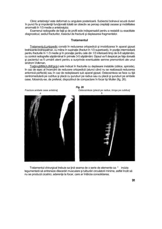 Clinic antebraţu! este deformat cu angulare posterioară. Subiectul bolnavul acuză dureri
în punct fix şi impotenţă funcţională totală iar obiectiv se percep crepitaţii osoase şi mobilitatea
anormală în 1/3 medie a antebraţului.
Examenul radiografie de faţă şi de profil esîe indispensabil pentru a restabili cu exactitate
diagnosticul, sediul fracturilor, traiectul de fractură şi deplasarea fragmentelor.
Tratamentul
Tratamenţu)Lprtppedlc constă în reducerea ortopedică şi imobilizarea în aparat gipsat
brahioante-brahiopalmar, cu mâna în supina|ie (fracturi în 1/3 superioară), în poziţie intermediară
pentru fracturile în 1 /3 medie şi în pronaţie pentru cele din 1/3 inferioară timp de 6-8 săptămâni,
cu control radiografie săptămânal în primele 3-5 săptămâni. Gipsul va fi despicat pe faţa dorsală
şi pacientul va fi urmărit atent pentru a surprinde eventualele semne premonitorii ale unui
sindrom Volkman,
Traţ|imgMMichJiMi'gicji-l sste Indicat în fracturile cu deplasare instabile (oblice, spiroide),
In caz de eşec al încercării de reducere ortopedică (atunci când nu se realizează reducerea
antomică perfectă) sau în caz de redeplasare sub aparat gipsat, Osteosinteza se face cu tijă
centromedulară pe cubîtus şi placă cu şuruburi pe radius sau cu placă şi şuruburi pe ambele
oase, folosindu-se, de preferat, dispozitivul de compactare în focar tip Muller (fig, 26).
Fractura ambele oase antebraţ
a
Fig. 26
Osteosinteza (placă pe radius, broşa pe cubitus}
b
Tratamentul chirurgical trebuie sa ţină seama de o serie de elemente ca: * incizia
tegumentară să antreneze dilacerări musculare şi tulburări circulatorii minime, astfel încât să
nu se producă cicatrici, aderenţe la focar, care ar întârzia consolidarea;
91
 
