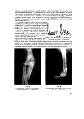 cubitusului, asociată cu (imitarea mişcărilor de flexie-extensie datorită luxatîei radiusului, motiv
pentru care se afirmă elastic, că iuxaţia este totul, fractura nu este nimic (afirmaţie ce trebuie
interpretată în sensul luării în considerare şi căutării unei posibile luxaţii de cap radial în cazul
unei fracturi cubitale). în fractura-luxa|ie tipică, la limitarea mişcărilor se adaugă şi posibilitatea
fracţionării ramului profund, motor al radialului (de către extremitatea proxîrnală a radiusului,
dislocată anterior), cu consecinţe negative asupra funcţionalităţii lojelor musculare posterioară
şi externă a antebraţului.
Datorită incidenţei mult mai mari 3 fracîurii-
luxaţiei tipice (numită şi fractura-luxaţie prin extensie
Watson-Jones) în raport cu cea inversată (fractura-
luxaţie prin flexie Watson-Jones), în cele ce
urmează va fi prezentată doar forma tipică (fig. 27).
Clinic, la inspecţie se observă antebraţul în
semiflexie şi pronaţie, deformarea cotului în sens
antero-posterior, cu bombarea plicii cotului şi
prezenţa unei înfundări sub condilul numeral
extern, precum şi prezenţa unei
înfundări pe marginea cubitală a antebraţului. La
palpare se obiectivează datele furnizate de
inspecţie: întreruperea continuităţii osoase la nivelul crestei cubitale cu prezenţa unui unghi
deschis intern şi posterior, lipsa capului radial sub condilul numeral extern şi migrarea lui
anterioară. Eventual se pot decela crepîtaţii osoase în focarul de fractură cubitală. La
manevrele de mobilizare ale antebraţului întâmpinăm o rezistenţă elastică (fig. 28 şi fig. 29).
Fig. 28
Fractură-luxaţie, varietatea prin extensie cu
tuxaţfa antero-externă a capului radia!
Fig. 29
Fractură-luxaţie, varietatea prin flexie cu Iuxaţia
posterioară a capului radial
95
Fig. 27
Factură luxaţie MONTEGGIA-STĂNC1ULESCU
- varietatea prin flexie şi prin extensie
 