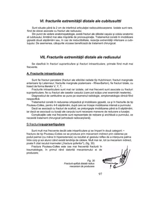 VI. fracturile extremităţii distale ale cubitusultti
Sunt situate până la 2 cm de interliniul articulaţiei radiocubitocarpiene. Izolate sunt rare,
fiind de obicei asociate cu fracturi ale radiusului.
Din punct de vedere anatomopatologie, există fracturi ale stiloidei capului şi colului anatomic
al cubitusului, limitând mai ales mişcările de pronosupinaţie. Tratamentul constă în imobilizare
gipsată două săptămâni sau, In caz de ireductibilitate, rezecţia extremităţii inferioare a cubi-
tuşului. De asemenea, căluşurile vicoase beneficiază de tratament chirurgical.
VIL Fracturile extremităţii distale ale radiusului
Se clasifică în fracturi suprarticufare şi fracturi intraarticulare, primele fiind mult mai
frecvente.
A. Fracturile intraarticulare
Sunt fie fracturi parcelare (fracturi ale stiloîdei radiate tîp Hutchinson; fracturi marginale
anterioare tip Letenneur; fracturile marginale posterioare - Rhea-Barton), fie fracturi totale, cu
traiect de forma literelor V, Y, T,
Fracturile intraarticulare sunt mat rar izolate, cel mai frecvent sunt asociate cu fracturi
supraarticulare, fie cu fracturi ale oaselor carpului (care pot scăpa unei examinări neatente),
Diagnosticul de certitudine se pune pe examenul radiologie, simptomatologia clinică fiind
nespeciflcâ.
Tratamentul constă în reducerea ortopedică şl imobilizare gipsată, ca şi în fracturile de tip
Pouteau-Colles, pentru 4-6 săptămâni, după care se începe mobilizarea intensă a pumnului.
Dacă se asociază cu fracturi de scafoid, se prelungeşte imobilizarea până ia 8 săptămâni,
iar dacă se asociază cu luxaţii ale carpului sunt necesare manevre de reducere a luxaţiei.
Complicaţiile cele mai frecvente sunt reprezentate de redoare şi anchiloză a pumnului, ce
necesită tratament chirurgical (artrodeză radiocarpîană}.
S.fracturiieşupraartigulare
Sunt mult mai frecvente decât cele intaartîculare şi se împart în două categorii: •
fractura de tip Pouteau-Colies ce se produce prin mecanism indirect prin căderea pe
podul paimei (cu mâna în hiperextensie) ca rezultat a! gestului reflex de a interpune palma
între corp şi soi atunci când există tendinţa de cădere. Mult mai rar, tot ca mecanism indirect,
poate fi citat reculul manivelei („fractura şoferilor"), (fig, 30)
Fractura Pouteau-Colles este cea mai frecventă fractură în
traumatologie, în primul rând datorită mecanismului ei de
producere;
Fig. 30
Fractură epifiză distată radius
mecanism de producere
97
 