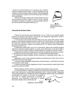 • fractura tip Goyrand-Smtth care se produce prin mecanism
indirect de cădere pe dosul mâinii, cu mâna în hiperflexie. Se mai
numeşte şi „fractura Pouteau-Coltes inversată", întrucât deplasările
şi deci manevrele de reducere sunt invers decât cele din fractura
tip PouteathColles.
Fracturile tip Pouteau-Colles apar la toate vârstele, dar sunt
mai frecvente la femeiie în vârstă, în tirnp ce la copii, datorită
persistentei cartilajului de creştere, se produc dezlipiri epifizare
sau fracturi-decoiări aie epifizeî distale (fig. 31).
fig. 31
Fractură-decolare a
epifizei distale humeraie
(la copil}
Fracturile t/p Pouteau-Colies
Traiectul de fractură este situat extraarticular, la cea. 15-25 mm {cu posibile variaţii)
deasupra articulaţiei radiocarpiene. importante sunt deplasările fragmentului distal şi
consecinţele funcţionale ale acestor deplasări,
în mod normal, în plan frontal, linia orizontală şt linia care uneşte vârful apofizei stîloide
radiate cu vârful stiloidei cubttale formează un unghi de 30° deschis intern, iar în plan sagital,
fata inferioară a radiusului priveşte în jos şi înainte, marginea posterioară fiind situată inferior
de nivelul celei anterioare, unghiul cu orizontala fiind de 10° deschis anterior Deplasările
fragmentului inferior sunt:
Q deplasarea posterioarâ în jurul unui ax transversal, astfel încât suprafaţa articulară
inferioară a radiusului priveşte posterior; ca urmare, apare deformarea „în dos de furculiţă" a
mânii şr din punct de vedere funcţionai, limitarea flexiei şi a mişcărilor de precizie a mâinii;
Q deplasarea proximală se realizează prin penetrarea fragmentului proxima!, mai dens,
în cel distal mai puţin dens (spongios), având ca rezultat angrenarea fragmentelor;
Q deplasarea laterală {radială) produce devierea cu unghiulaţia axului mâinii „în
baioneta".
Deplasările în plan frontal limitează mişcările de prehensiune şi forţă, fiind mai bine
suportate decât cele în plan sagital.
în ceea ce priveşte stabilitatea, aceasta este cu atât mai redusă, cu cât traiectul de fractură
este mai oblic în sens cubitaî,
în fractura tip Goyrand-Smiih, deplasarea se face în sens proximal şi anterior dând mâinii
aspectul de „burtă de furculiţă".
Simptomatologia constă în durere şi impotenţă funcţională la nivelul pumnului.
La examenul obiectiv, inspecţia evidenţiază echimoză palmară discretă ce se întinde
ulterior spre antebraţ dar, rnai ales deformarea gâtului mâinii fn „dos de furculiţă". Deplasarea
în sens antero-posterior se evidenţaiză din profil, iar deplasarea radială din faţă, axul antebraţului
nemaitreeând prin medius ci mai intern prin degetul IV
(sau chiar V), apărând deformarea în baionetă. De
asemenea, prin deplasarea posterioară a epifizei,
tendoanele radialilor devin evidente {fig. 32).
fig, 32
Deplasare în „dos de furculiţă"
98
 