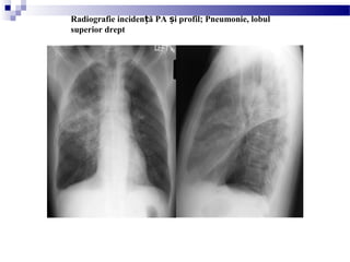 Radiografie inciden ă PA i profil; Pneumonie, lobulț ș
superior drept
 