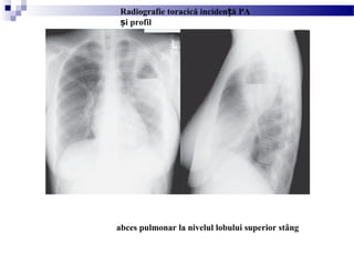 abces pulmonar la nivelul lobului superior stâng
Radiografie toracică inciden ă PAț
i profilș
 