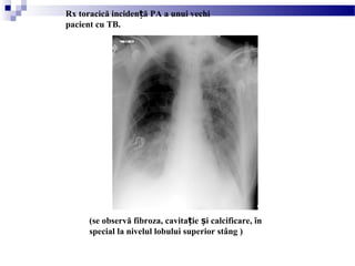 Rx toracică inciden ă PA a unui vechiț
pacient cu TB.
(se observă fibroza, cavita ie i calcificare, înț ș
special la nivelul lobului superior stâng )
 