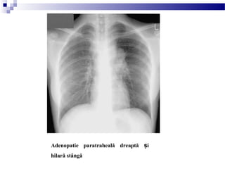 Adenopatie paratraheală dreaptă iș
hilară stângă
 