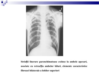 Stria ii linerare parenchimatoase extinse la ambele apexuri,ț
asociate cu retrac ia ambelor hiluri, elemente caracteristiceț
fibrozei bilaterale a lobilor superiori
 