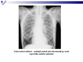 Tuberculoză miliară – multipli noduli mici disemina i pe toatăț
suprafa a ambilor plămâniț
 