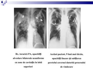 Rx. toracică PA, opacită iț
alveolare bilaterale neuniforme
cu zone de cavita ie în lobiiț
superiori
Acelasi pacient, 9 luni mai târziu,
opacită i lineare i sub iereaț ș ț
peretelui cavernei datorită procesului
de vindecare
 
