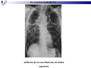 (infiltrate i caverne bilaterale ale lobilorș
superiori)
Rx. toracică, inciden ă PAț
 
