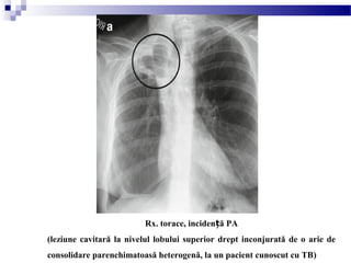 Rx. torace, inciden ă PAț
(leziune cavitară la nivelul lobului superior drept inconjurată de o arie de
consolidare parenchimatoasă heterogenă, la un pacient cunoscut cu TB)
 