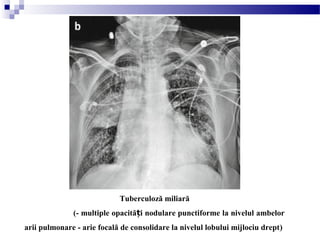 Tuberculoză miliară
(- multiple opacită i nodulare punctiforme la nivelul ambelorț
arii pulmonare - arie focală de consolidare la nivelul lobului mijlociu drept)
 
