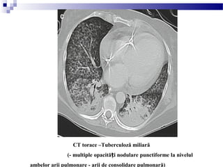 CT torace –Tuberculoză miliară
(- multiple opacită i nodulare punctiforme la nivelulț
ambelor arii pulmonare - arii de consolidare pulmonară)
 
