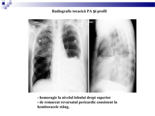 - hemoragie la nivelul lobului drept superior
- de remarcat revarsatul pericardic consistent în
hemitoracele stâng.
Radiografie toracică PA i profilș
 