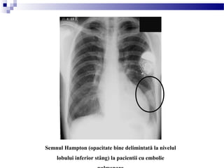 Semnul Hampton (opacitate bine delimintată la nivelul
lobului inferior stâng) la pacientii cu embolie
 