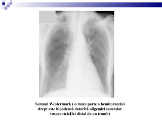 Semnul Westermark ( o mare parte a hemitoracelui
drept este hipodensă datorită oligemiei secundar
vasocontric iei distal de un tromb)ț
 