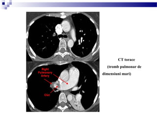 CT torace
(tromb pulmonar de
dimensiuni mari)
 