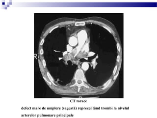 CT torace
defect mare de umplere (sageată) reprezentând trombi la nivelul
arterelor pulmonare principale
 