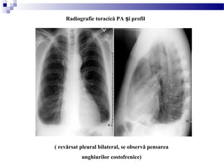 ( revărsat pleural bilateral, se observă pensarea
unghiurilor costofrenice)
Radiografie toracică PA i profilș
 