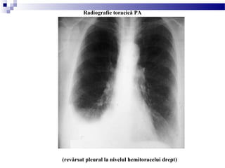 (revărsat pleural la nivelul hemitoracelui drept)
Radiografie toracică PA
 
