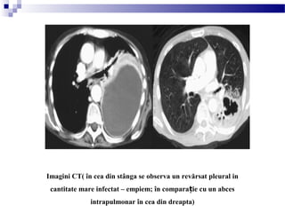 Imagini CT( în cea din stânga se observa un revărsat pleural in
cantitate mare infectat – empiem; în compara ie cu un abcesț
intrapulmonar în cea din dreapta)
 