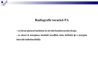 Radiografie toracică PA
- revărsat pleural inchistat la nivelul hemitoracelui drept;
- se observă marginea medială ascu ită, bine definită i o margineț ș
laterală indistinctibilă)
 