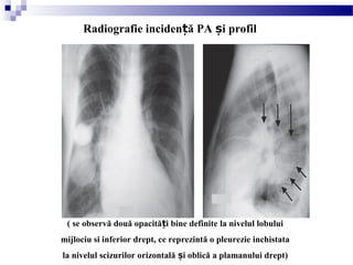 ( se observă două opacită i bine definite la nivelul lobuluiț
mijlociu si inferior drept, ce reprezintă o pleurezie inchistata
la nivelul scizurilor orizontală i oblică a plamanului drept)ș
Radiografie inciden ă PA i profilț ș
 