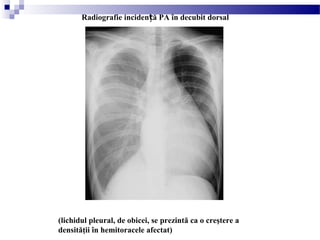 (lichidul pleural, de obicei, se prezintă ca o creştere a
densităţii în hemitoracele afectat)
Radiografie inciden ă PA în decubit dorsalț
 