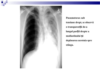Pneumotorax sub
tensiune drept, se observă
o transparen ă de-aț
lungul par ii drepte aț
mediastinului iș
deplasarea acestuia spre
stânga.
 
