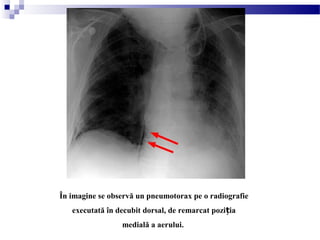 În imagine se observă un pneumotorax pe o radiografie
executată în decubit dorsal, de remarcat pozi iaț
medială a aerului.
 