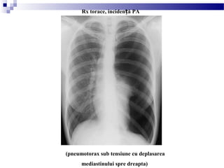 (pneumotorax sub tensiune cu deplasarea
mediastinului spre dreapta)
Rx torace, inciden ă PAț
 