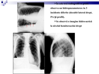 În cele trei radiografii se poate
observa un hidropneumotorax in 3
incidente diferite (decubit lateral drept,
PA i profil).ș
Se observă o imagine hidro-aerică
la nivelul hemitoracelui drept
 