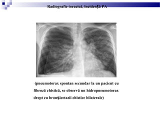 (pneumotorax spontan secundar la un pacient cu
fibroză chistică, se observă un hidropneumotorax
drept cu bron iectazii chistice bilaterale)ș
Radiografie toracică, înciden ă PAț
 