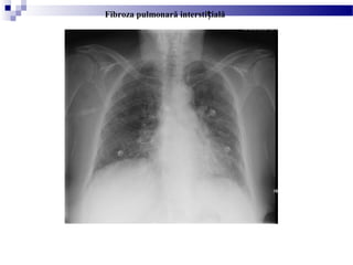 Fibroza pulmonară intersti ialăț
 