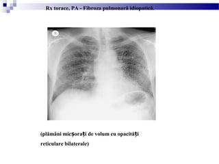 (plămâni mic ora i de volum cu opacită iș ț ț
reticulare bilaterale)
Rx torace, PA - Fibroza pulmonară idiopatică.
 
