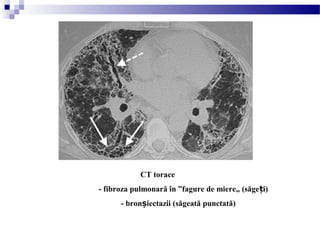 CT torace
- fibroza pulmonară în ”fagure de miere„ (săge i)ț
- bron iectazii (săgeată punctată)ș
 