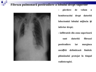 - pierdere de volum a
hemitoracelui drept datorită
lobectomiei lobului mijlociu iș
inferior drept;
- infiltratele din zona superioară
sunt datorită fibrozei
postiradiere iar marginea
ascu ită delimitează limiteleț
plămânului protejat în timpul
radioterapiei.
Fibroza pulmonară postiradiere a lobului drept superior
 