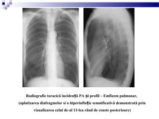 Radiografie toracică inciden ă PA i profil – Emfizem pulmonar,ț ș
(aplatizarea diafragmelor si o hiperinfla ie semnificativă demonstrată prinț
vizualizarea celui de-al 11-lea rând de coaste posterioare)
 