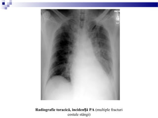 Radiografie toracică, inciden ăț PA (multiple fracturi
costale stângi)
 