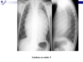 Limfom cu celule T
 