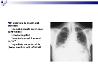 Un exemplu de inspir slab
efectuat:
numai 4 coaste anterioare
sunt vizibile
cardiomegalie?
masă – la nivelul arcului
aortic?
opacitate neuniformă la
nivelul ambilor lobi inferiori?
 