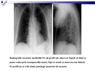 Radiografie toracică, inciden ă PA i profilț ș (de observat faptul că hilul se
poate vedea prin transparen a masei, fapt ce arată ca masa nu este hilarăț )
Pe profil nu se vede nimic patologic posterior de aceasta.
 