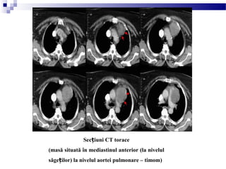 Sec iuniț CT torace
(masă situată în mediastinul anterior (la nivelul
săge ilor) la nivelul aortei pulmonare – timomț )
 