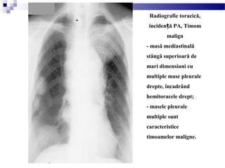 Radiografie toracică,
inciden ă PA, Timomț
malign
- masă mediastinală
stângă superioară de
mari dimensiuni cu
multiple mase pleurale
drepte, încadrând
hemitoracele drept;
- masele pleurale
multiple sunt
caracteristice
timoamelor maligne.
 