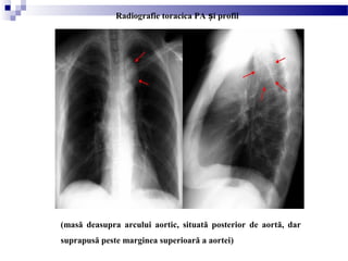 (masă deasupra arcului aortic, situată posterior de aortă, dar
suprapusă peste marginea superioară a aortei)
Radiografie toracica PA i profilș
 