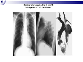 Radiografie toracica PA i profil,ș
aortografie – anevrism aortic
 
